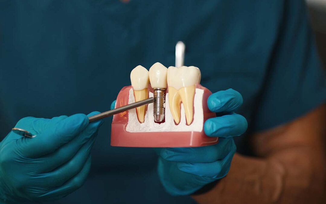 Cos’è l’implantologia dentale?