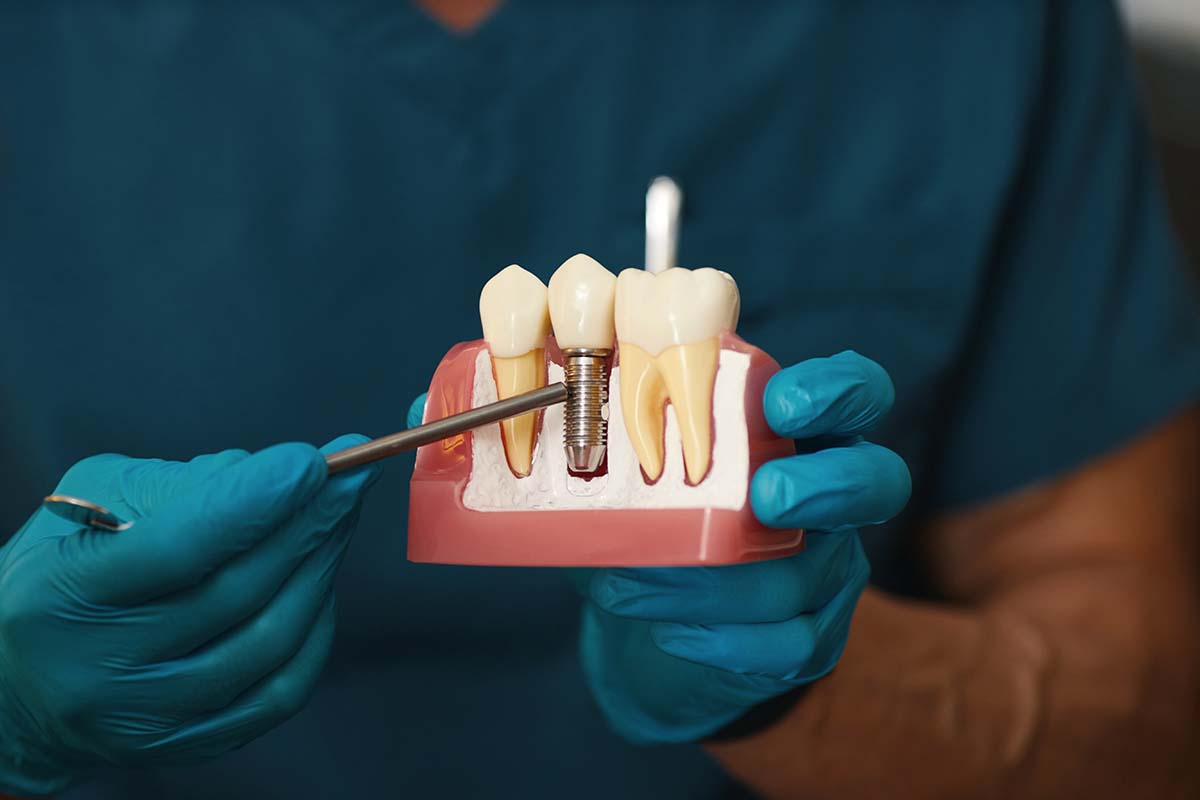 Impianti Dentali Impianti Dentali