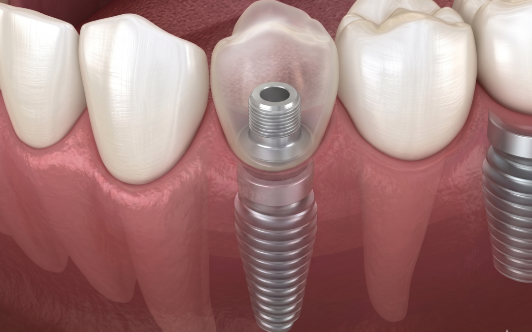 Come mantenere puliti impianti dentali