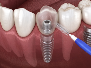 Igiene orale con scovolino per impianti dentali