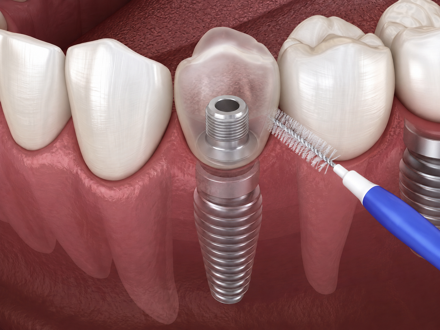 Igiene orale con scovolino per impianti dentali