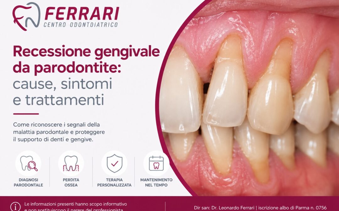 Recessione gengivale da parodontite: cause e trattamenti