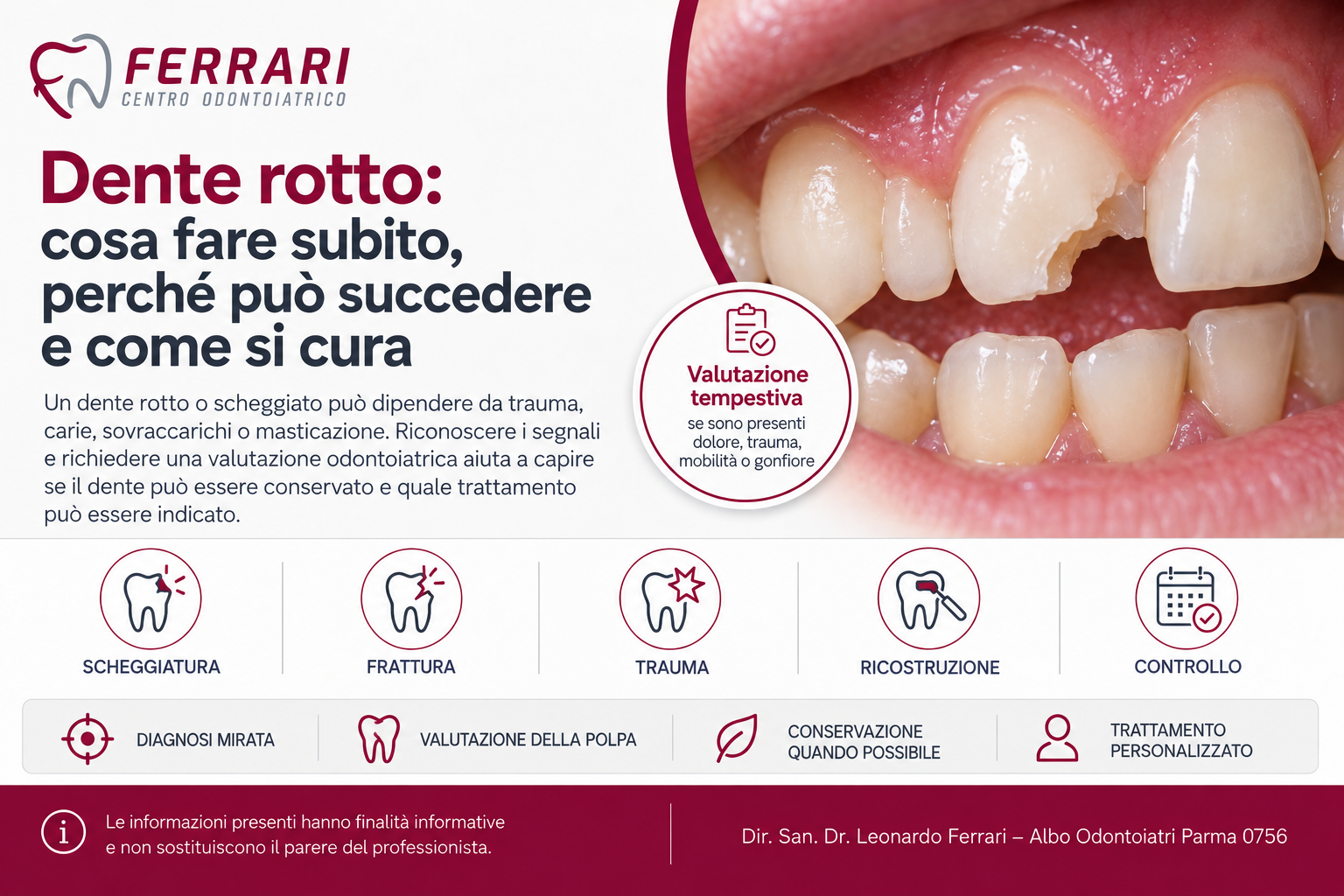 Dente rotto o scheggiato con perdita di una parte della corona dentale